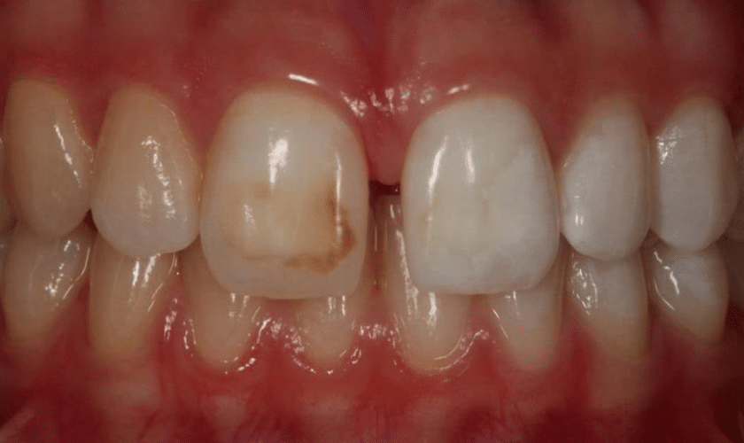 How Do You Get Coffee Stains Off Your Teeth Fast