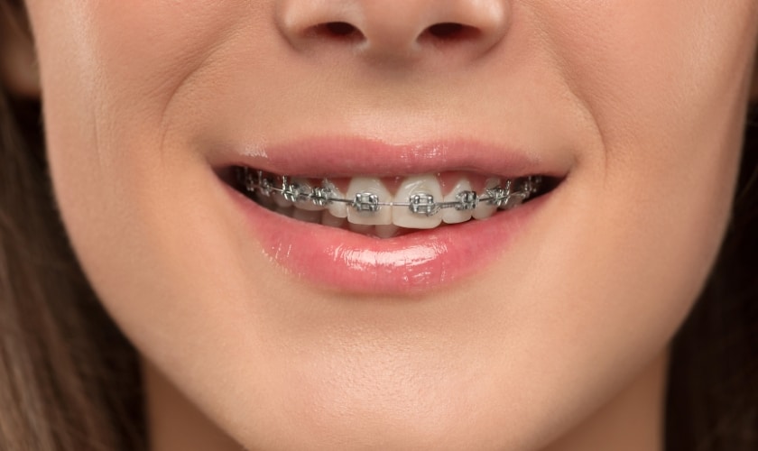 clear braces in Phoenix